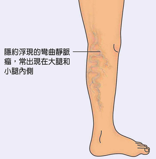 靜脈曲張-示意圖2-隱約浮現的彎曲靜脈瘤，常出現在大腿和小腿內側
