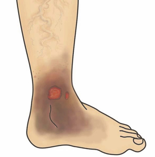 靜脈曲張-示意圖3-如果放任惡化沒有治療、皮膚會逐漸出現濕疹及潰瘍