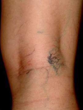 網狀靜脈擴張-示意圖2-大腿外及膝部附近的藍色網狀靜脈