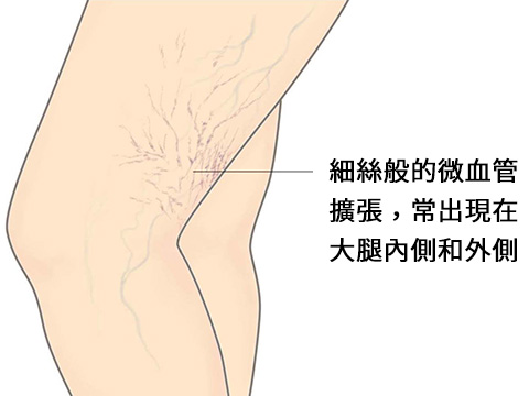 微血管擴張-示意圖-細絲般的微血管擴張，常出現在大腿內側和外側