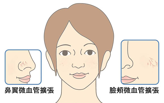 臉部的微血管擴張-示意圖-鼻翼微血管擴張、臉頰微血管擴張