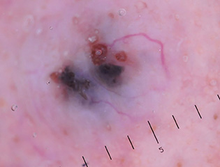 皮膚鏡檢查 志勛皮膚科診所vnus Dermatology Clinic 靜脈曲張 指甲矯正 痘疤治療 雷射治療 皮膚疾患 醫學美容 皮膚鏡檢查 志勛皮膚科診所vnus Dermatology Clinic 靜脈曲張 指甲矯正 痘疤治療 雷射治療 皮膚疾患 醫學美容