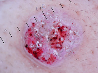 皮膚鏡檢查 志勛皮膚科診所vnus Dermatology Clinic 靜脈曲張 指甲矯正 痘疤治療 雷射治療 皮膚疾患 醫學美容 皮膚鏡檢查 志勛皮膚科診所vnus Dermatology Clinic 靜脈曲張 指甲矯正 痘疤治療 雷射治療 皮膚疾患 醫學美容